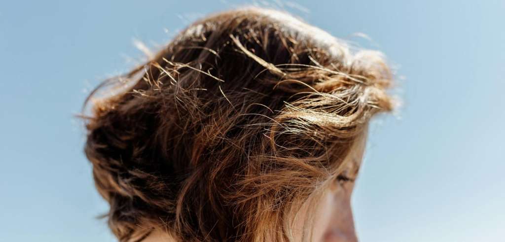 Alopecia androgénica en mujeres