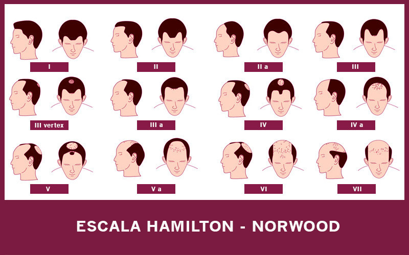 Escala Hamilton-Norwood de alopecia en hombres