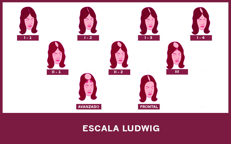 Escala de Ludwig de alopecia femenina