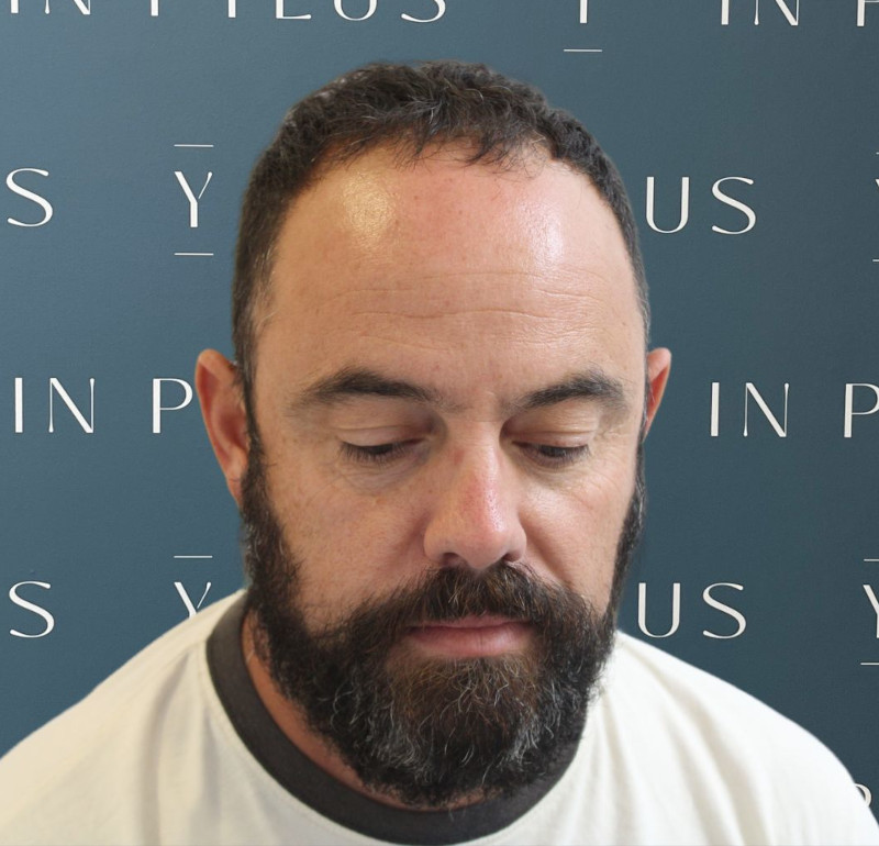 inpylus
