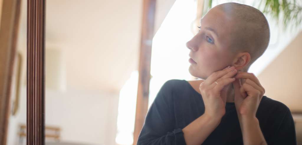 Alopecia Androgénica Femenina